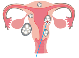 Ablación de miomas por radiofrecuencia: un tratamiento ambulatorio definitivo.